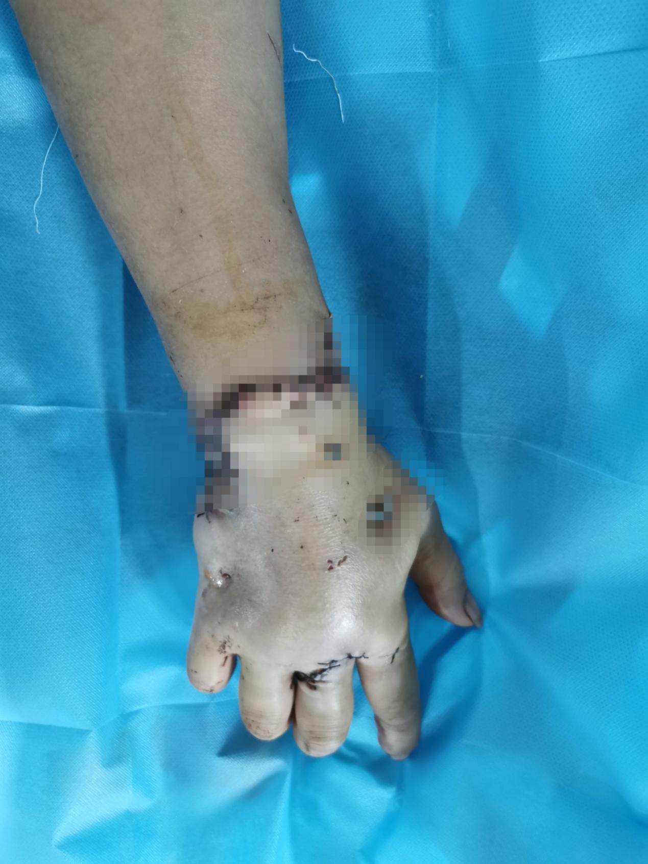 女子右臂完全离断病情危重我院对口支援队员联合东兴分院成功复活断肢