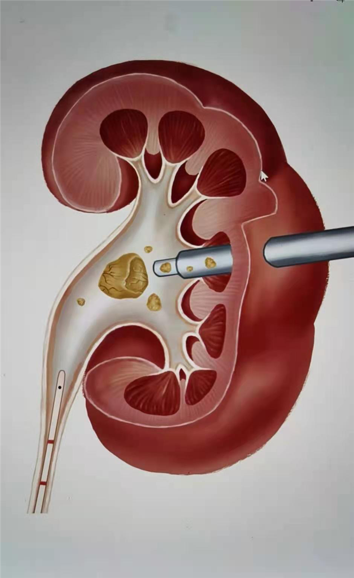 肾结石示意图图片