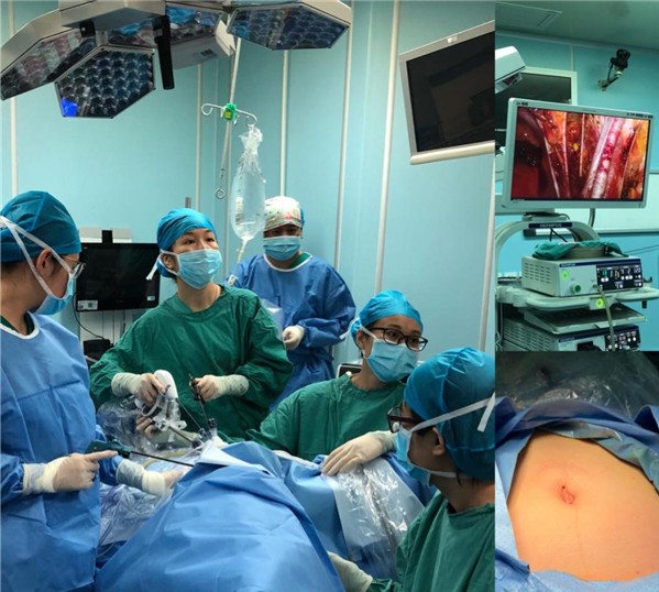 陈军莹医师团队完成单孔腹腔镜下宫颈癌根治术