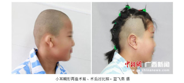 中新网、人民网等多家媒体共同关注：广西整形专家为小耳畸形女童成功造出新耳朵