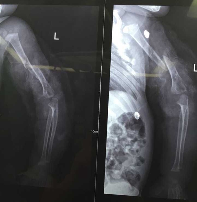 【惊险过关】创伤骨科手外科手术团队奋战5个半小时 成功保住梧州被扶梯“咬”伤男童手臂
