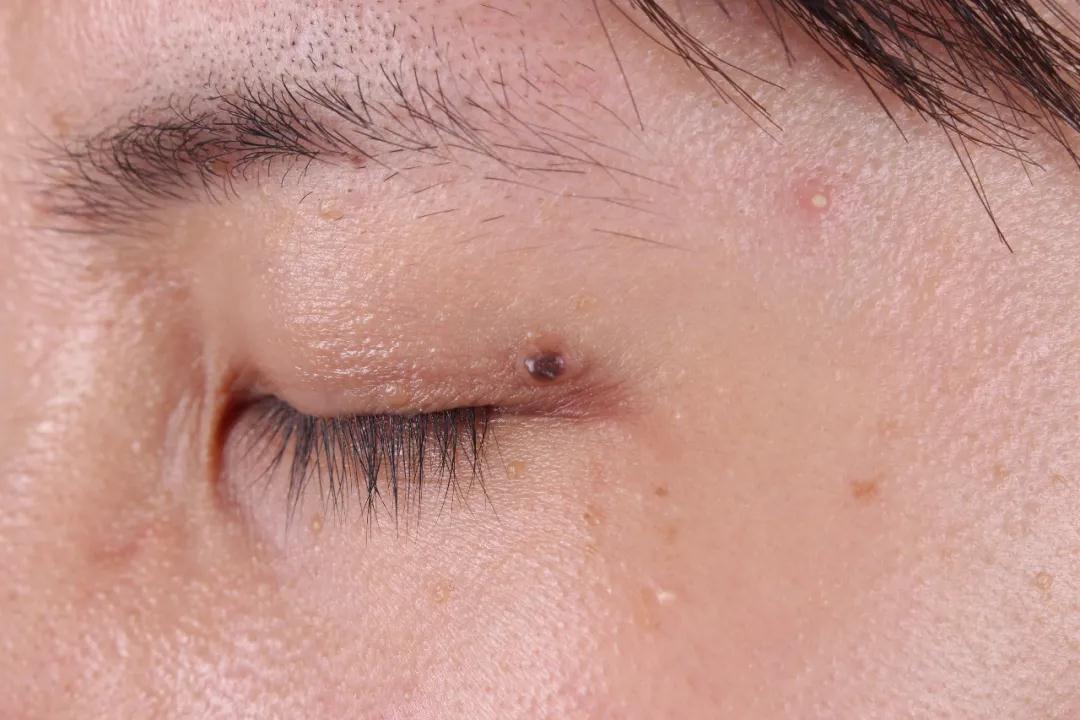 身上这些痣，当心会恶变 | 今晚22：30【医科全说】​