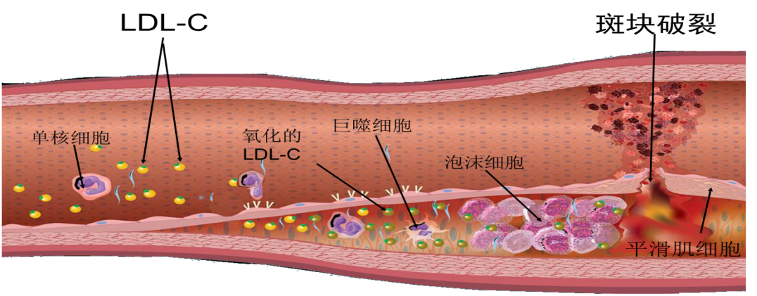 71岁大爷多次晕厥,颈动脉里竟长出“骨头”!医生说这病中老年人好发