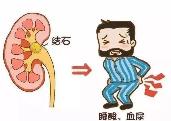 广西是结石病高发区！这年龄段的人注意：预防结石最好的方法是……