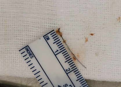 13岁男孩误吞牙箍弓丝！若穿破胃部，后果不堪设想