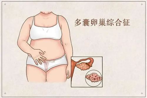 我有点胖,毛发有点多,很难怀孕吗?丨附多囊卵巢综合征自检方式