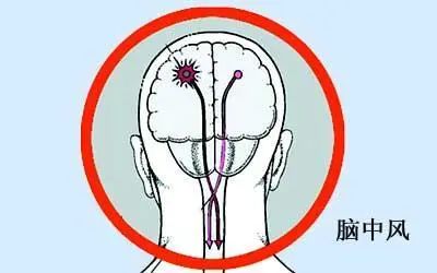 每21秒钟就有1人死于中风！果断收藏：如何远离健康“第一杀手”？