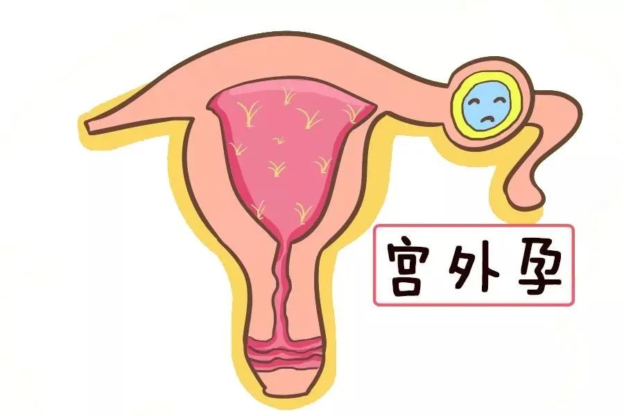 侧睡会导致宫外孕吗？睡觉姿势会导致着床失败吗？