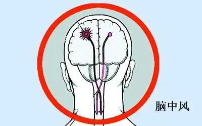 中风很可怕，离我们每个人都很近......丨世界预防中风日