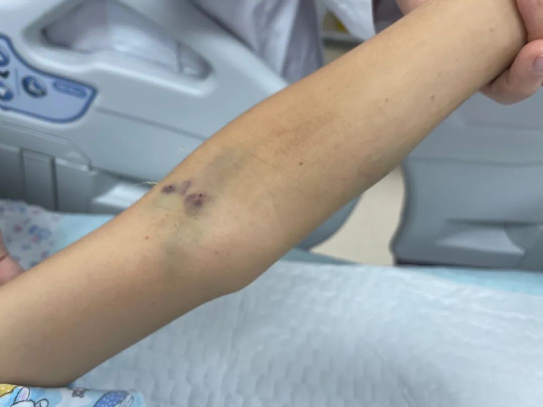 毒蛇凶猛！广西9岁男孩凝血功能极度异常被送进ICU，竟是被这种蛇咬伤（多图慎点）