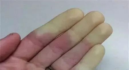 皱纹消失，我返老还童了？ 小心！这可能是硬皮病