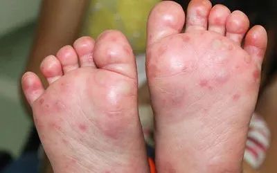 手足口病又来了？做好这几点就不用怕~