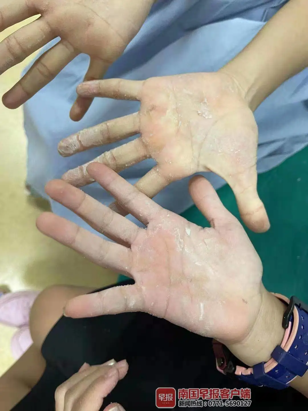 两个孩子遭恶作剧，手掌被502胶牢牢粘住！我院小儿外科医生一个办法成功解救