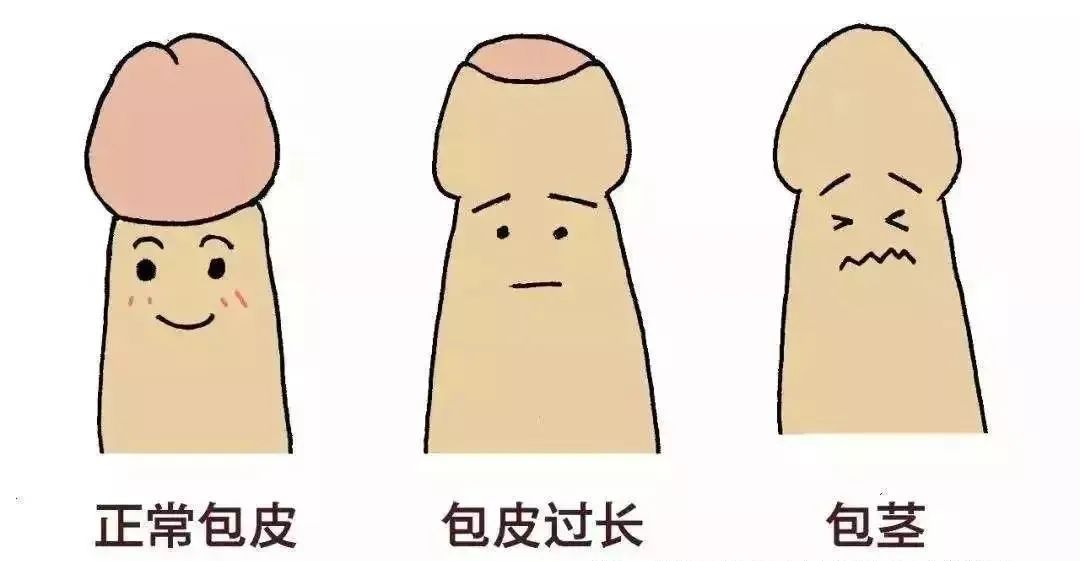 又到一年中排队修“丁丁”的时候啦，要不要割包皮？专家告诉您