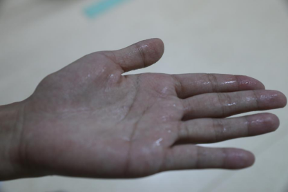 滴答滴……手心大汗淋漓让人尴尬，胸外科团队1天11台手术解决“手汗症”