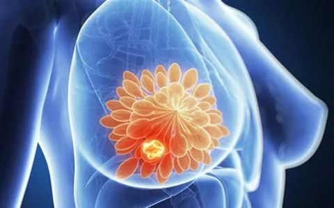 乳腺癌城市发病率高于农村，已成广西女性重点防控癌种！这些自查方法一定要学会