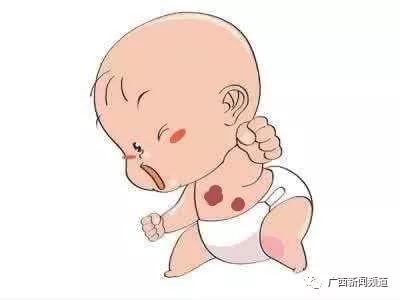 治疗小儿皮肤血管瘤，核医学科有法宝 | 医科全说