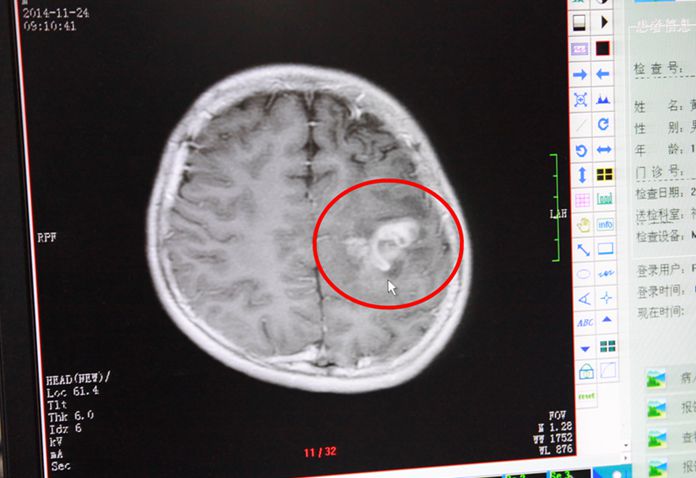 我院神经外科为两名患者从脑部取出裂头蚴寄生虫