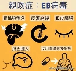 【辟谣】有EB病毒流感？医生说根本没这病