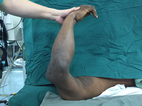 非洲友人畸形7年手臂终获矫正 我院创伤骨科手外科,广西援助非洲医疗