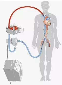 生死竞速时刻 救命神器发威：我院ECMO（体外膜肺氧合）团队又一次成功救治年轻重症肺炎患者