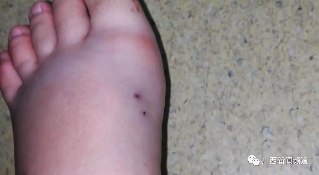 蛇出没！又有人在公园被毒蛇咬伤，专家支招遇蛇如何自保自救