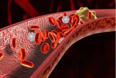 【医科全说】深静脉血栓——“沉默的杀手”