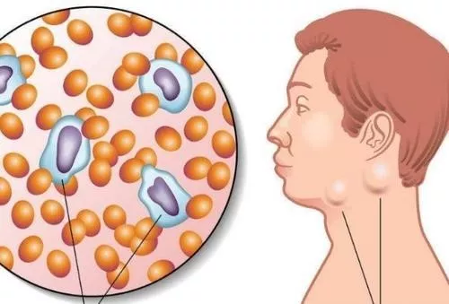 攻击身体免疫系统的这个肿瘤都是恶性的，但医生说可以治愈