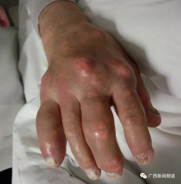 痛风能否治愈？ 预防和治疗痛风的方法有哪些？ | 今晚《医科全说》