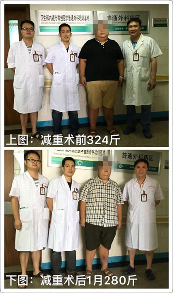 广西微创外科团队乐成实现广西首例减重手术