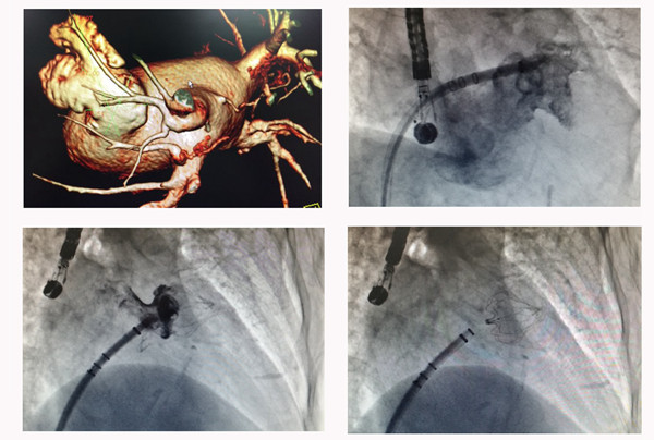 左心耳ct及造影
