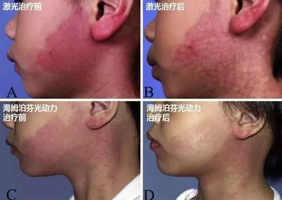 【医科全说】鲜红斑痣不是普通胎记 治疗要趁早