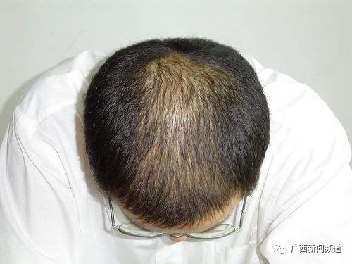 【医科全说】90后还没脱单就脱发？趁秋天把头发养起来