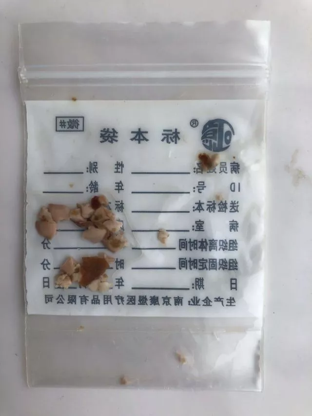 【惊险】3岁女孩咳嗽20多天险夺性命，竟是因为一颗小小的……