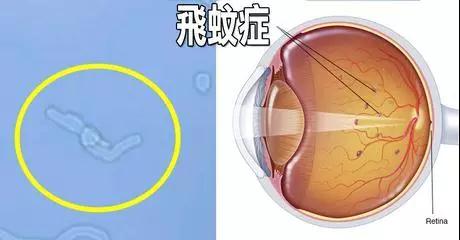 【医科全说】眼前出现飞蚊、闪光或者黑幕， 当心视网膜脱离造成视力下降或失明
