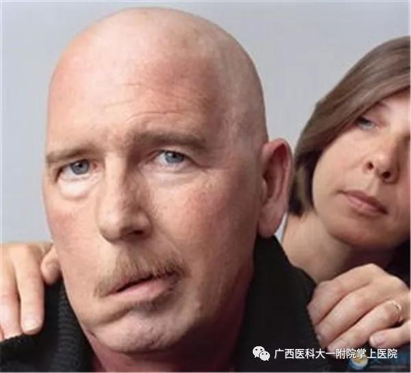 嘴斜眼歪怎么办？广西医科大学第一附属医院高压氧科能治