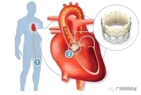 【医科全说】先天性心脏病95%以上可治愈，您知道吗？