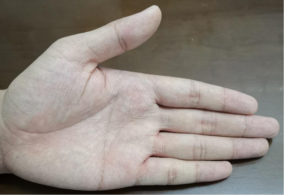 术后手掌干燥温暖