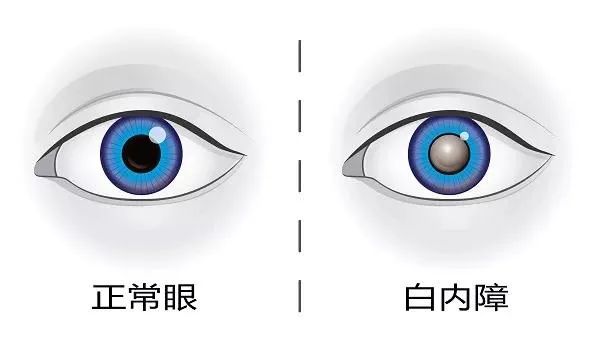 眼睛看不清老花眼还是白内障简单判断