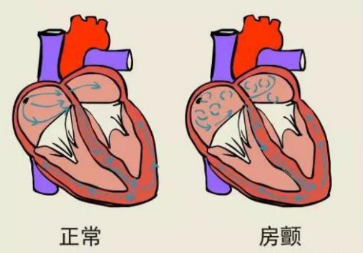漏服、多服新型口服抗凝药的房颤患者怎么办？别慌，不同措施帮你补救