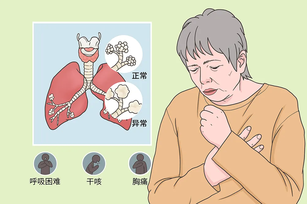 反复干咳、憋喘别大意，这种“肺炎”不简单丨间质性肺疾病专科门诊