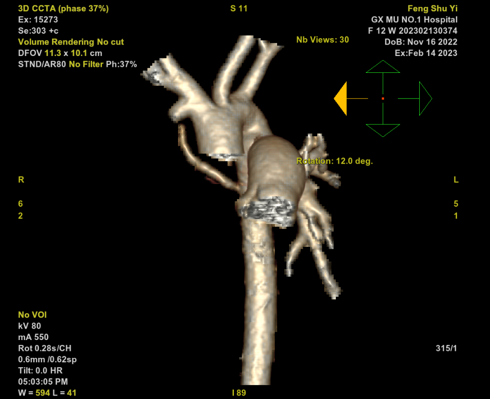 “新装备”助力手术远程会诊 | 我院与广东心脏外科专家共同救治罕见心脏病婴儿