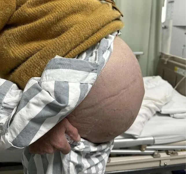 全身肿胀，腹部如鼓，多家医院求诊，竟是罕见的“铃铛病”！