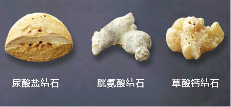 肾结石与钙片：一场“钙”与“石”的误会