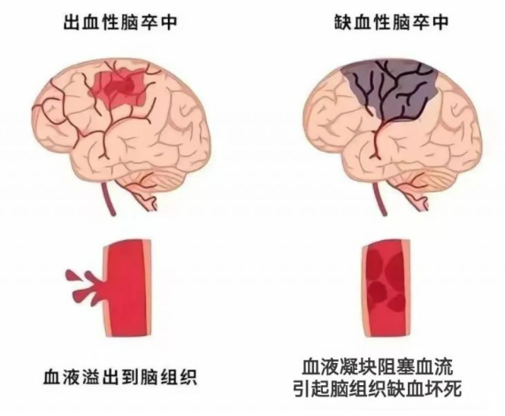 气温骤降，这类疾病高发，如何远离寒风中的“隐形杀手”？