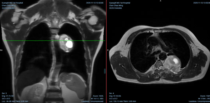 肿瘤横跨脊柱与胸腔！广西医科大一附院多学科创新协作，以小切口成功手术