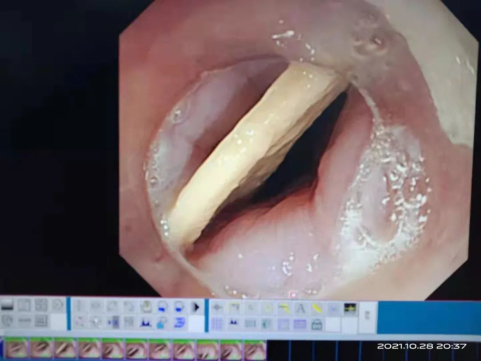 鱼骨卡穿食管命悬一线 ,多学科团队与泌尿外科紧急成功救治