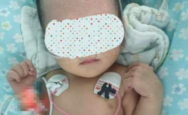 突破最低体重记录！儿科心血管团队成功为2.7kg新生儿实施动脉导管未闭封堵术